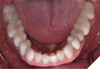 Mandibular occlusal view,
post-treatment. 