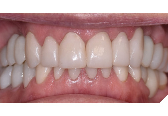 Maximum intercuspation, post-treatment.