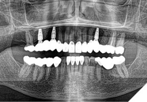 Etiology and management of a common and complex dental problem: Tooth ...
