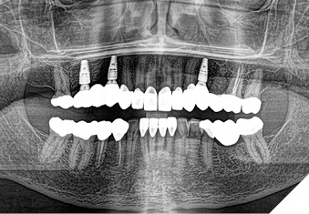 Post-operative panoramic radiograph.