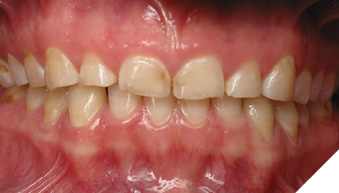 Patients with moderate and severe attrition.