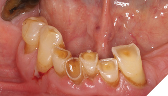 Patients with moderate and severe attrition.