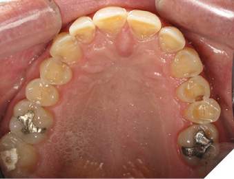 Erosive lesions on palatal surfaces of maxillary teeth, most likely due to gastric regurgitation.