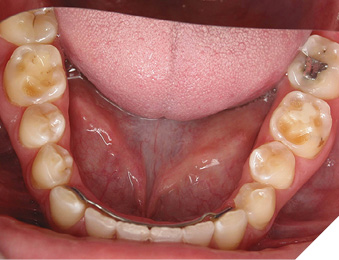 “Restoration halo” on posterior mandibular teeth, where acid has eroded tooth structure surrounding restorations. 