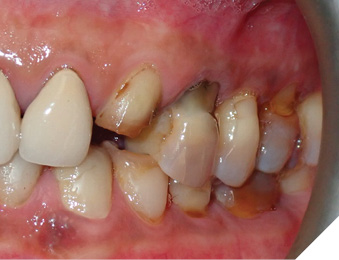 Multiple abfraction lesions on maxillary teeth.