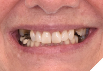  Pre-operative smile. 