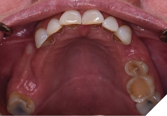 Maxillary occlusal view. See the wear of the palatal and occlusal wear of maxillary teeth.