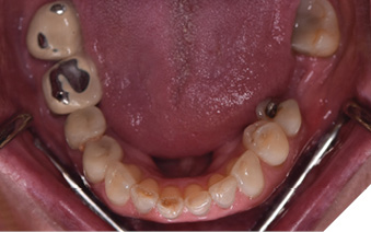Mandibular occlusal view. See the worn down porcelain on crowns on teeth 46 and 47. There is also chipped composite on mandibular anterior teeth. 