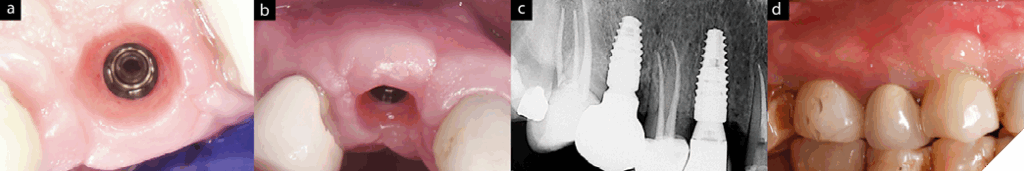 Clinical features of healthy peri-implant tissue. 1-a: Adequate mucosal thickness 1-b. Adequate vertical soft tissue thickness, 1-c: Radiograph shows ‘marginal bone(biological) stability’ for #15-9 years, #13-5 years post-loading bone levels, 1-d. Soft tissue profile is robust with long-term stability.