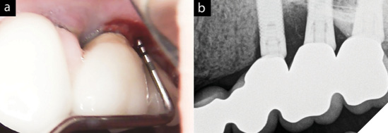 Clinical presentation of the Peri-implantitis around the implant-supported prosthesis. Intra-oral image(a) shows probing depth near 12mm with profuse bleeding and the corresponding radiograph (b) shows significant bone loss around the implant fixtures.