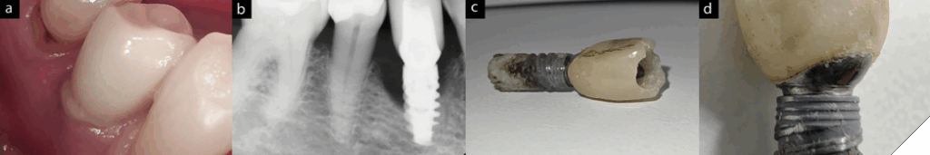 5A. Clinical presentation shows suppuration upon pressure on the buccal mucosa. 5B. Radiograph shows extensive bone loss resulting in the removal of implant. 5C. A trephine bur was used to remove the failing implant and screw-retained crown. 5D. Close-up image shows the micro-gap between the cemented(in the lab) crown and the abutment. Often, the seal quality of margin is over-looked by a clinician and this must be examined by a clinician before insertion. Additionally, one area of the restorative margin is very close(short gingival height) to the implant shoulder being an additional threat to crestal bone stability.