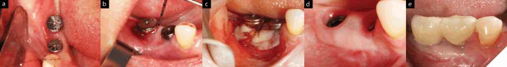  Peri-implant mucositis with soft tissue management. A. Lack of keratinized tissue and minimal vestibule as a risk factor for progression of peri-implant diseases. b. Thin mucosal thickness with almost zero vertical soft tissue thickness with BoP. c. Free gingival graft to enhance peri-implant soft tissue profile. d. Soft tissue phenotype modification is achieved with adequate amount of mucosal thickness and vertical soft tissue thickness. e. Re-insertion of the prosthesis.

