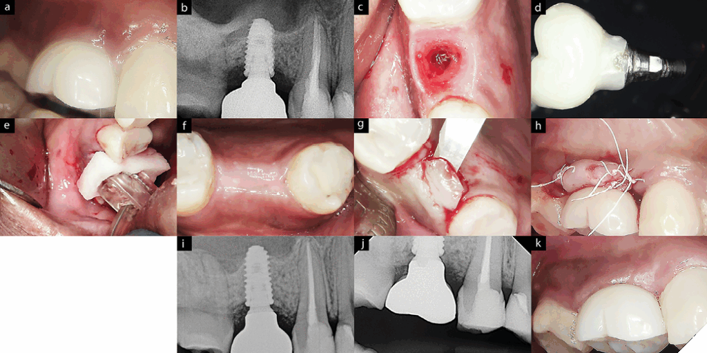 Early intervention of surgical therapy on peri-implantitis with mild bone loss on a screw-retained crown on #16. A. Edematous gingival margin with suppuration. B. Radiograph shows about 20% of marginal bone loss. C. Eryth-
ematous internal gingiva with bleeding is evident upon removal of the crown. D. Screw-retained crown with discrepant restorative margin.
E. ‘Galvosurg ‘was utilized for implant surface disinfection. F. Submerged healing protocol. G. After 4 months, second stage performed with apically positioned flap to position palatal keratinized tissue to buccal side of the crown. H. The same crown was inserted after disinfecting the crown margin (Remake of a new crown recommended but denied by the patient). I. 6-months post-op radiograph shown ‘crestal bone stability’ with bone fill materials. J. 1-year post-op clinical presentation with absence of BoP and stable peri-implant tissue. K. 1-year post-op BW showing stable marginal bone level on #16. 7L. Galvosurg, Dental Implant Cleaning System.
