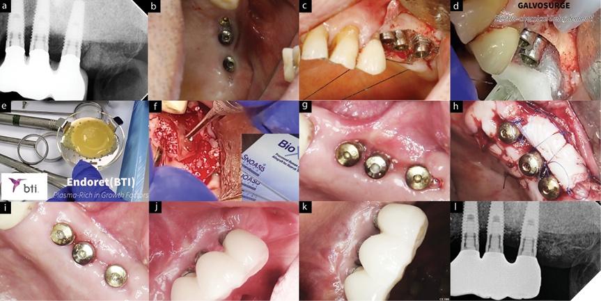 Late intervention of surgical therapy on peri-implantitis with extensive bone loss on. A. Initial status of bone level. B. Removal of the prosthesis. C. Open-flap debridement and surface disinfection.
D. Galvosurg application e. Endoret(PRGF) application. F. Bone substitute followed by Bioxclude membrane. G. After healing 2M.
H. Soft tissue phenotype modification with Free gingival graft. I. Healing after soft tissue grafting. J. Remake of prosthesis (Prosthodontics completed by Dr. Bo Huang). K-L. Robust soft tissue profile was evident in 3-year post. op. I. Marginal bone level seems similar to the initial state due to the osseous defect was not amenable for the regeneration (horizonal bone loss) however, the pocket reduction was achieved exposing implant-abutment junction(micro-gaps) for better cleansing performance and bone fill within the intra-bony defect (Fig.8-c).