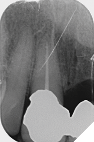 Upper right central incisor tooth.