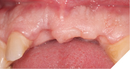 Healed sites prior to implant placement.