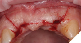 Papilla sparing h shaped crestal.