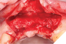 Exposed alveolar ridge preplacement.