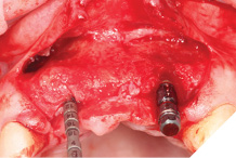 Direction indicator in place UR1 and implant placed UL2.