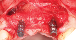 Implants in situ.