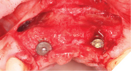 Implants in autogenous bone.