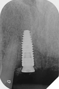 UR1 implant placement radiograph.