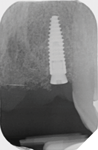 UL2 implant placement radiograph