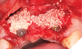 cerabone® xenograft biomaterial used
for contour ridge augmentation.