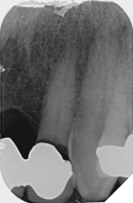 Grossly carious upper left central incisor.