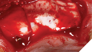 Jason® membrane used in situ.