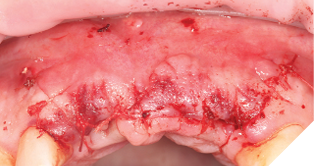 Closed site showing good primary closure