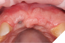 Healing after 10 weeks.