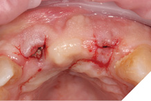 Small h shape crestal incisions to expose fixture heads.