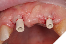 Mono-scan bodies in situ.