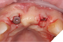 Three weeks after exposure with wider healing abutments in situ.