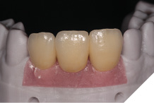 Provisional bridge fabricated.