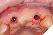 Healing site UR1 and widening of emergence profile prior to delivery of provisional bridge.