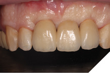 Provisional bridge in situ.