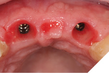 After 8 weeks to allow maturation of the soft tissue profile a new digital scan was taken with modified scan bodies to capture the now unique emergence profiles.