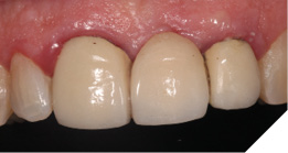 Intraoral appearance of presenting failing bridge.