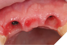 Matured soft tissue profile following customization with provisional bridge.