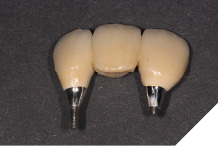 Definitive bridgework.