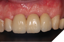 Fit of definitive bridgework.