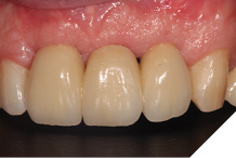 Fit of definitive bridgework.