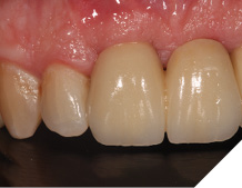 Fit of definitive bridgework.