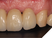 Fit of definitive bridgework.