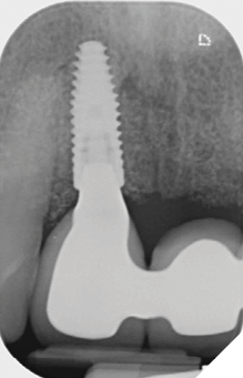 Radiograph of definitive bridge work: baseline bone levels around implant fixtures and excellent fit of metal framework.