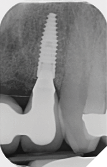 Radiograph of definitive bridge work: baseline bone levels around implant fixtures and excellent fit of metal framework.