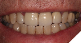 Extraoral appearance of metal ceramic bridge.