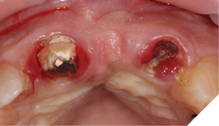Simple removal of the metal ceramic bridge.